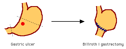 Diagram showing the transformation from a gastric ulcer to a Billroth gastrectomy with annotated sections of the stomach before and after surgery.