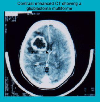 Contrast-enhanced CT scan image displaying a glioblastoma multiforme in the brain.