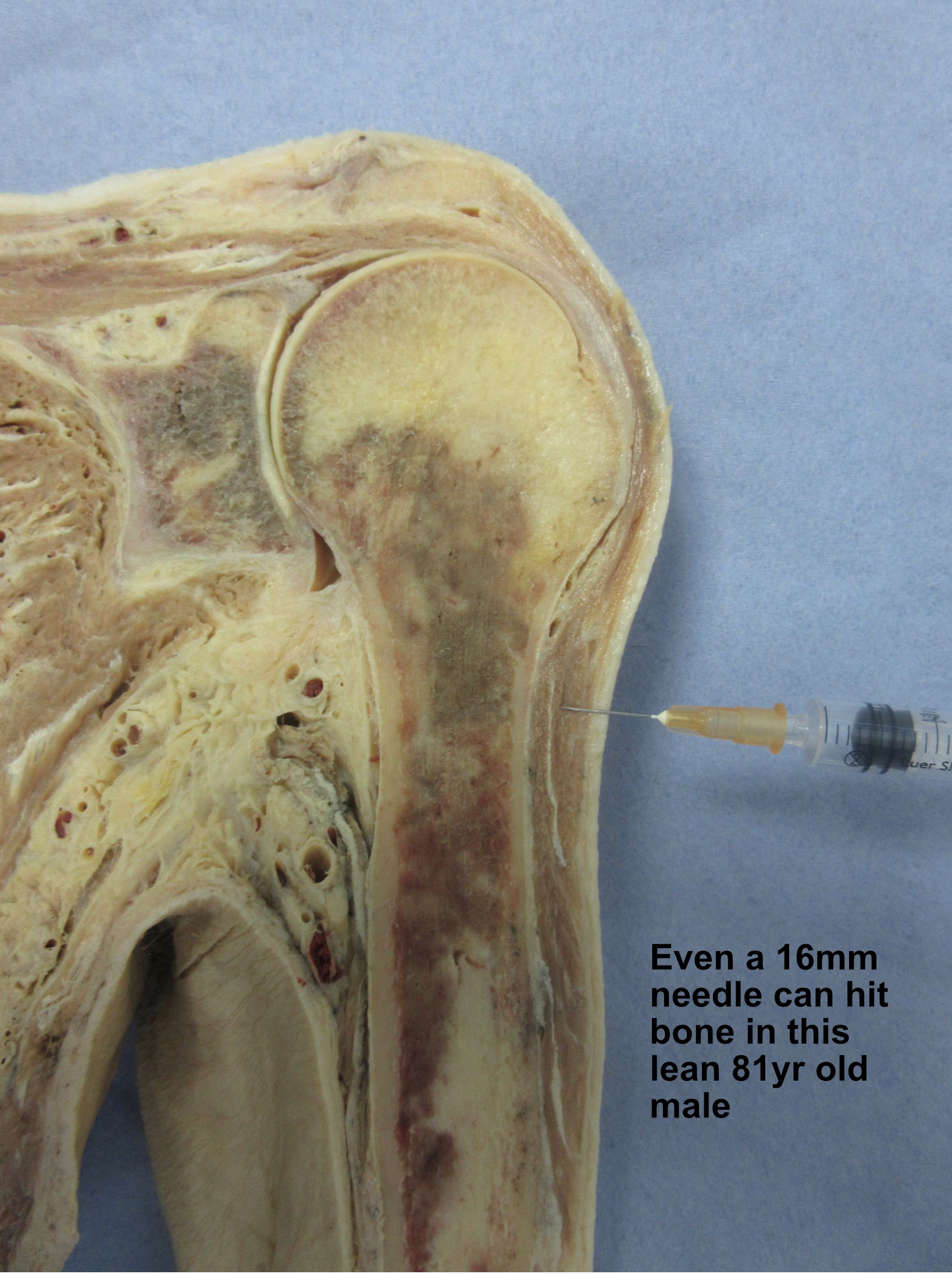 Close-up of a cross-section of human hip anatomy with a syringe demonstrating needle length relative to the bone depth, with annotation about needle penetration in an elderly male