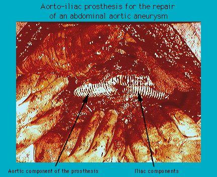 Close-up of an aorto-iliac prosthesis in a surgical setting used for abdominal aortic aneurysm repair, showing detailed labeling of the aortic and iliac components.