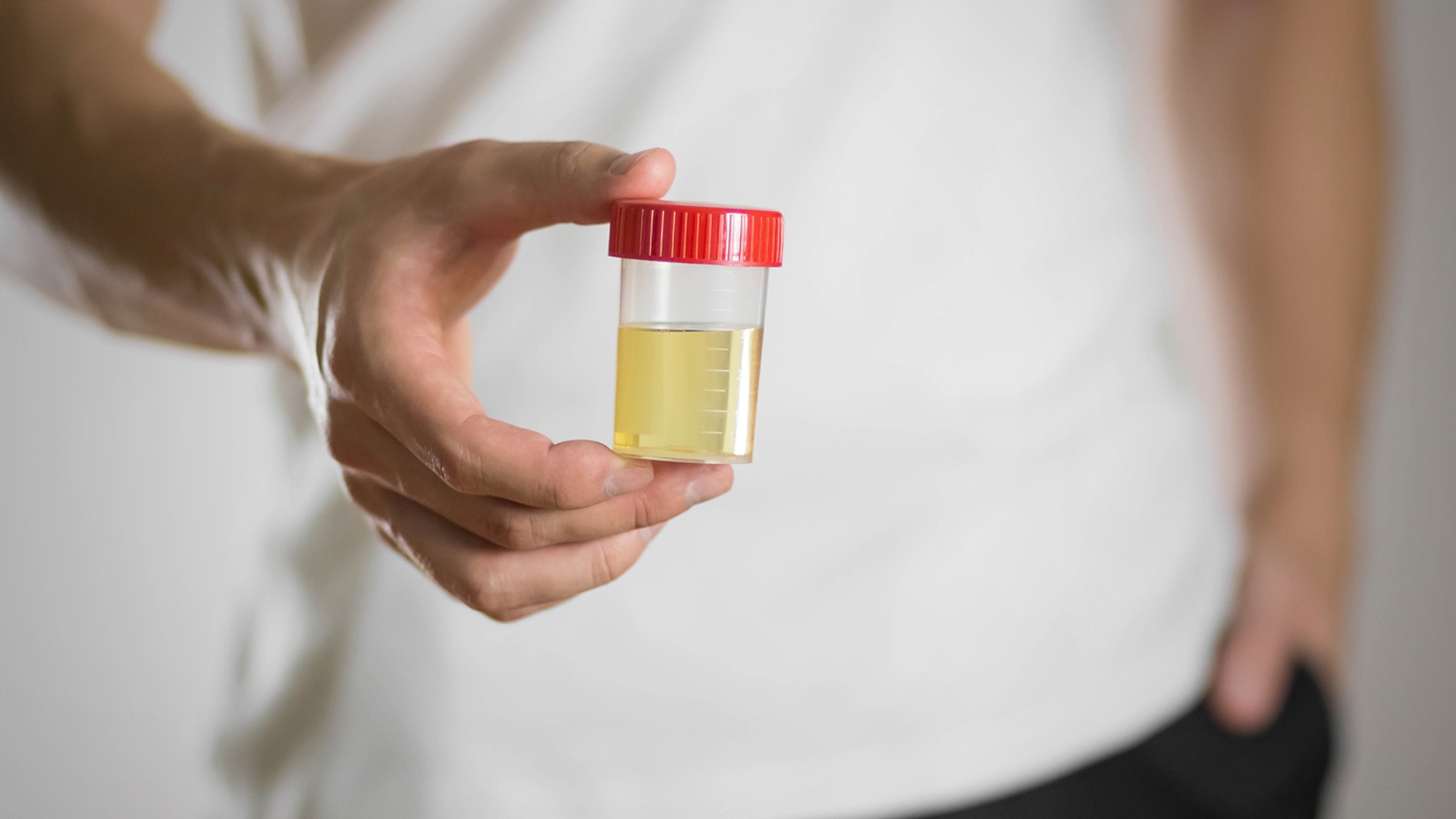 Person holding a small container with a red cap filled with urine for medical testing