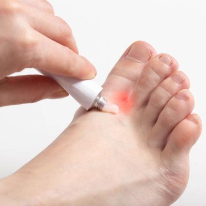 Hand applying topical cream from a tube to a red, inflamed spot on a foot.