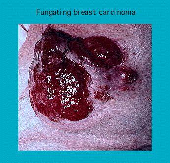 Close-up of fungating breast carcinoma showing large ulcers on the skin