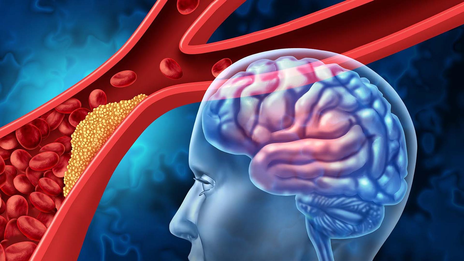 A blood vessel blocked by plaque, next to a transparent head showing a brain.