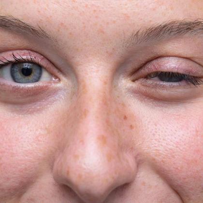 A person's face with one blue eye open and the other swollen and nearly closed.