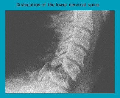 X-ray image showing a dislocation of the lower cervical spine