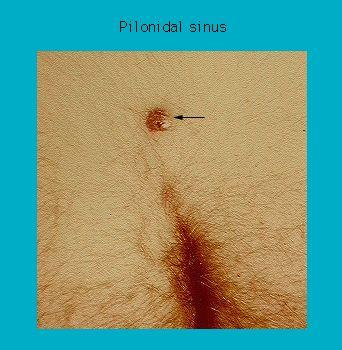 Close-up of a pilonidal sinus on human skin with an arrow pointing at the cyst near the top of the buttocks