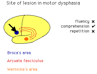 Diagram showing the site of lesion in motor dysphasia within the brain, highlighting Broca's area, Wernicke's area, and the arcuate fasciculus, with indicators for fluency, comprehension, and repetition abilities.