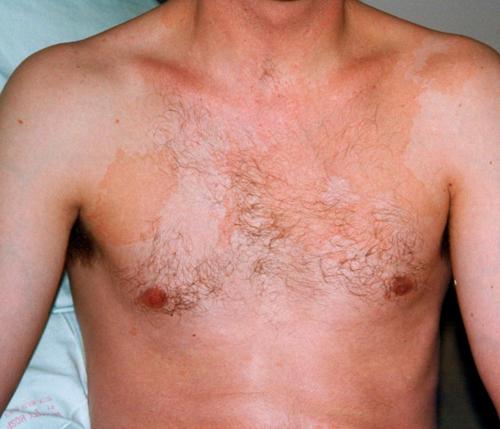 Close-up of a man's upper torso showing skin with mild sunburn and chest hair.
