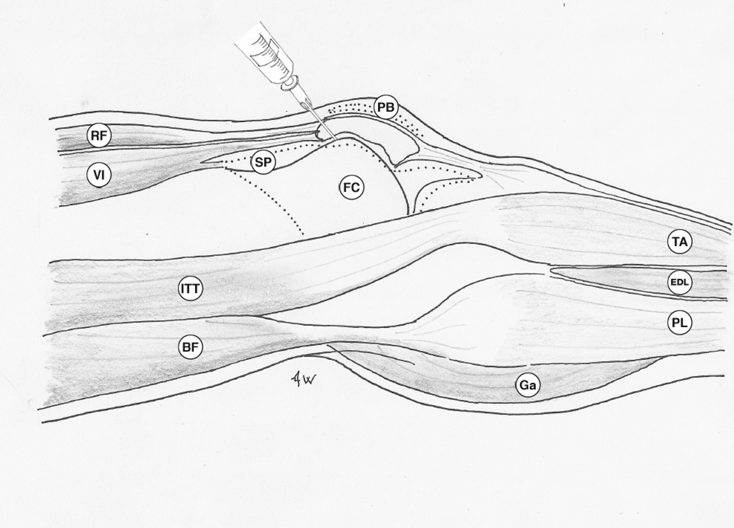 Lateral approach - aspiration or injection of the knee joint ...