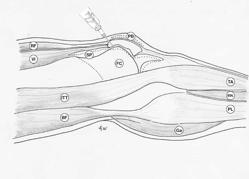 Lateral approach - aspiration or injection of the knee joint – Primary ...