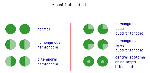 Hour Glass Field Defect Diagram of visual field defects – GPnotebook - GPNotebook