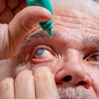 Close-up of an elderly man putting eye drops into his cloudy right eye.