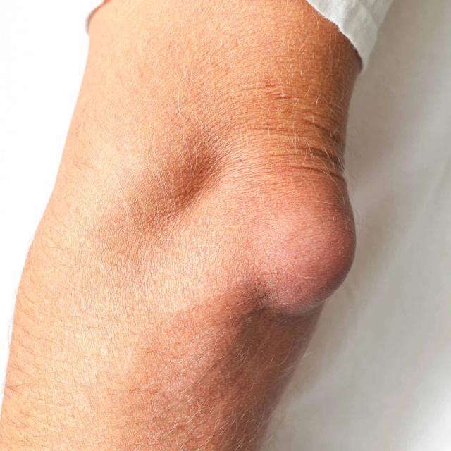 Elbow with a prominent, rounded swelling on the outer side.
