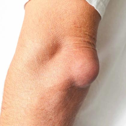 Elbow with a prominent, rounded swelling on the outer side.