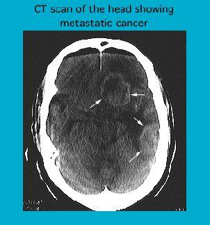 CT scan of a human head displaying areas affected by metastatic cancer, with marked lesions and abnormal tissue densities.