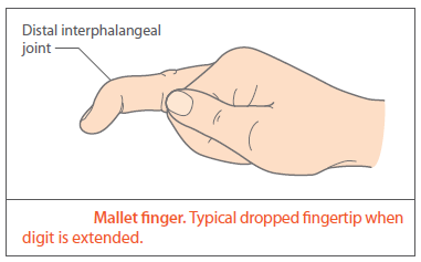 Illustration of a hand showing mallet finger condition with labeled distal interphalangeal joint and a dropped fingertip when the finger is extended.