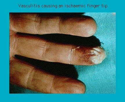 Close-up of a human hand showing three fingers with the tip of one finger discolored due to ischemia caused by vasculitis.