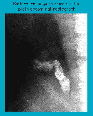 X-ray showing multiple radio-opaque gallstones in a plain abdominal radiograph
