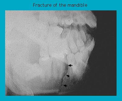 X-ray image showing a fractured mandible with marked fracture lines.