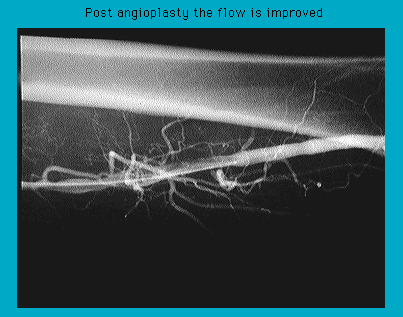 X-ray image showing improved blood flow in arteries post-angioplasty