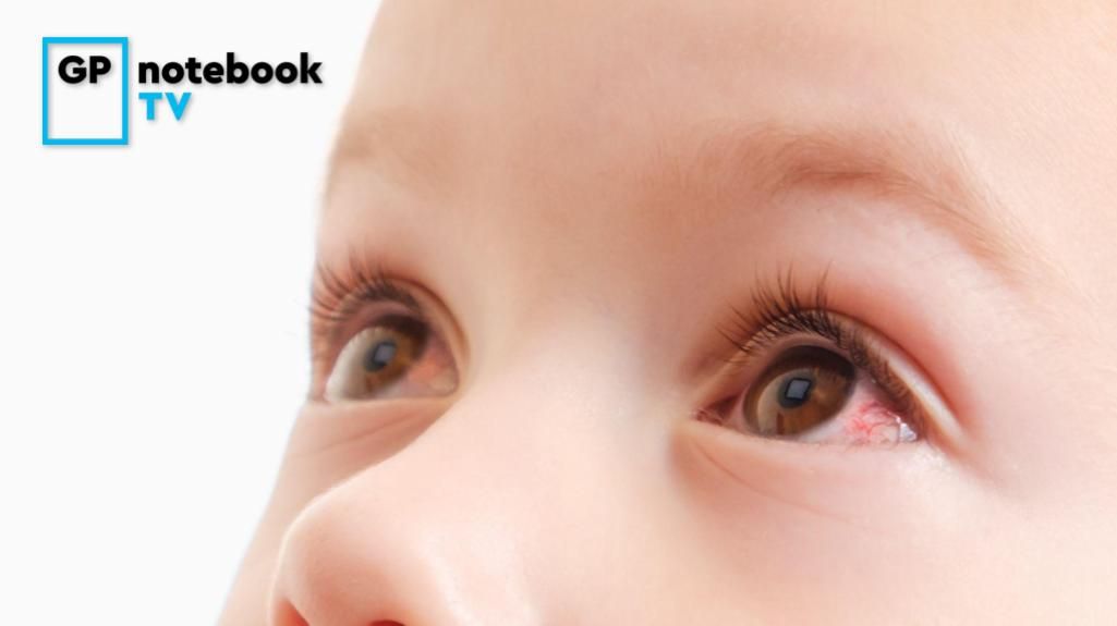Chloramphenicol eye drops containing borax or boric acid in children