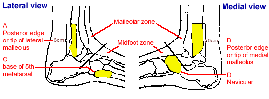 Ottawa Rules regarding requirement for ankle X-ray – GPnotebook