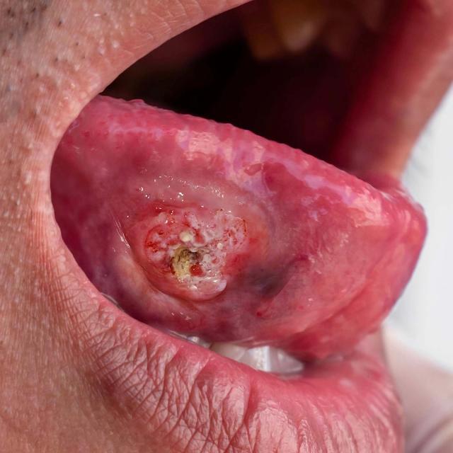 Close-up of a human tongue showing a large, irregular, ulcerated lesion with red, white, and yellowish areas.