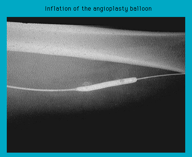 X-ray image showing the inflation of an angioplasty balloon inside a blood vessel.