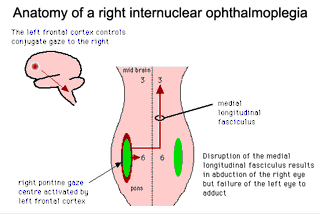 Diagram of the pathology in INO – GPnotebook - GPNotebook