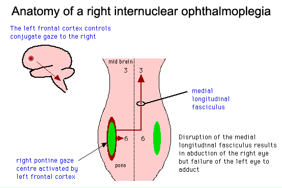 Diagram illustrating the anatomy of a right internuclear ophthalmoplegia, showing brain structures involved and the disruption of the medial longitudinal fasciculus.