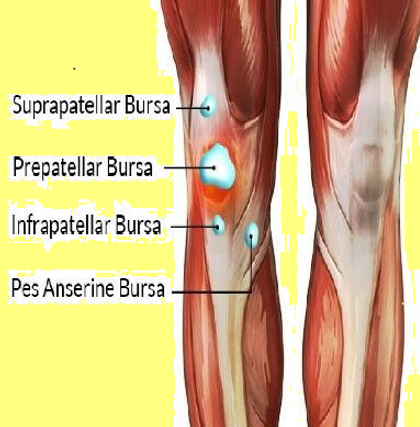 pes-anserine-bursitis-gpnotebook