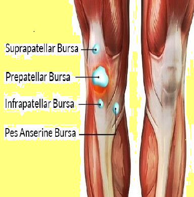 Pes Anserine Bursitis GPnotebook pes-anserine-bursitis-gpnotebook