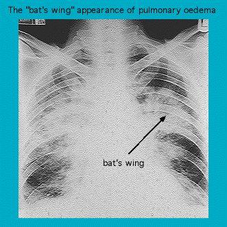 X-ray image showing the "bat's wing" appearance of pulmonary edema with a labeled arrow pointing to the affected area.