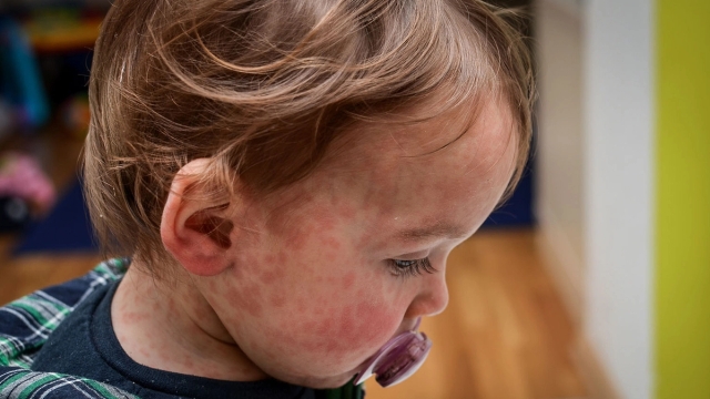 Childhood rashes: viral exanthems – GPnotebook