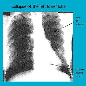 X-ray image showing collapse of the left lower lobe of a lung with annotations pointing to loss of volume and a shadow behind the heart.