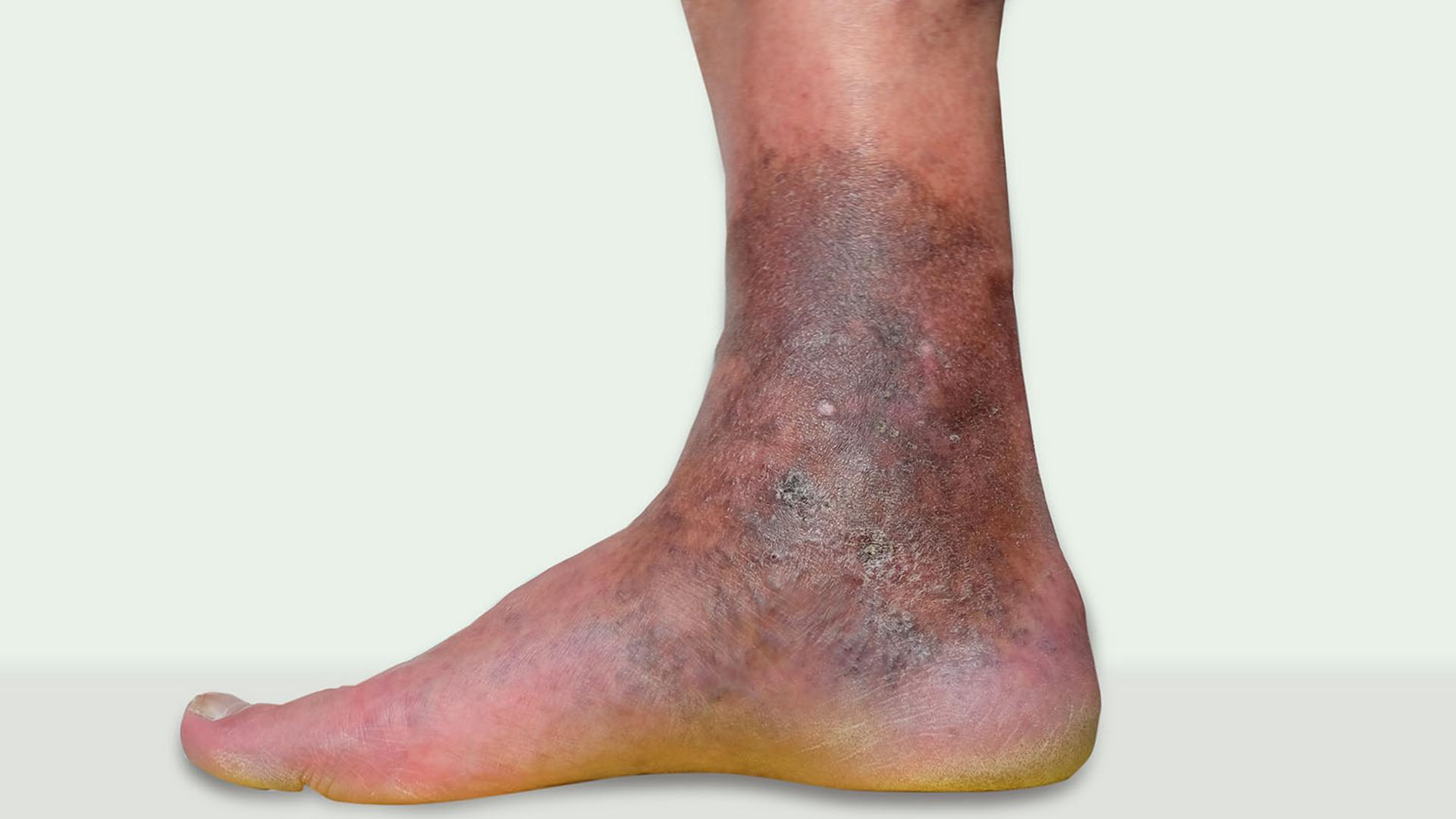 Lower leg and ankle with severe dark brown and purple skin discoloration.