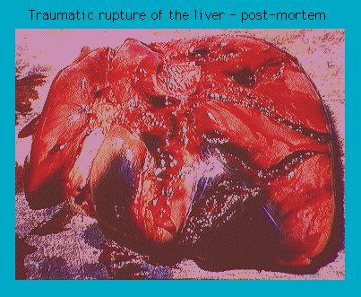 Post-mortem image showing a traumatic rupture of the liver with visible damage and discoloration