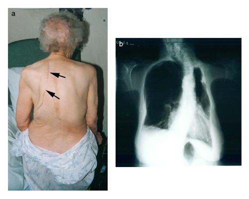 Elderly person with severe scoliosis indicated by arrows on the back, and a corresponding X-ray image showing spinal curvature
