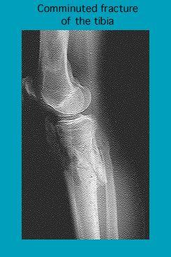 X-ray image showing a comminuted fracture of the tibia