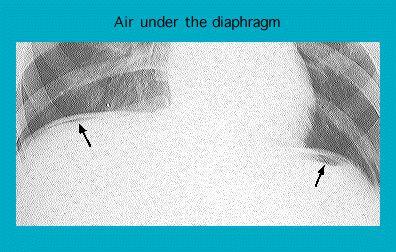 X-ray image showing air under the diaphragm with arrows indicating the presence of air