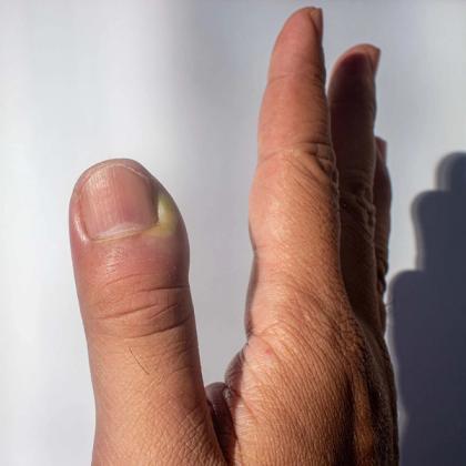 Close-up of a human thumb showing a yellow and green bruise under the nail, set against a shadowed background.
