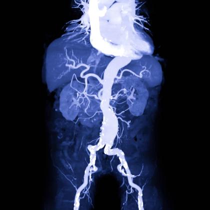 Blue-toned medical imaging scan showing detailed vascular structures in the human body.