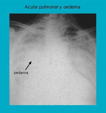 X-ray image showing acute pulmonary edema with marked region labeled as edema