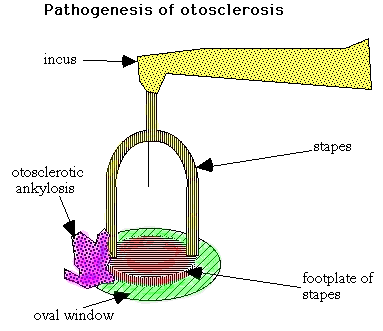 Diagram illustrating the pathogenesis of otosclerosis, showing the anatomical parts incus, stapes, otosclerotic ankylosis, footplate of stapes, and the oval window.