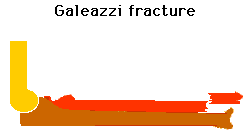 Illustration of a Galeazzi fracture showing displacement of the radius and the distal radioulnar joint.