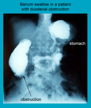 X-ray image of a barium swallow test showing a duodenal obstruction in a patient's digestive system, highlighting the stomach and area of obstruction.