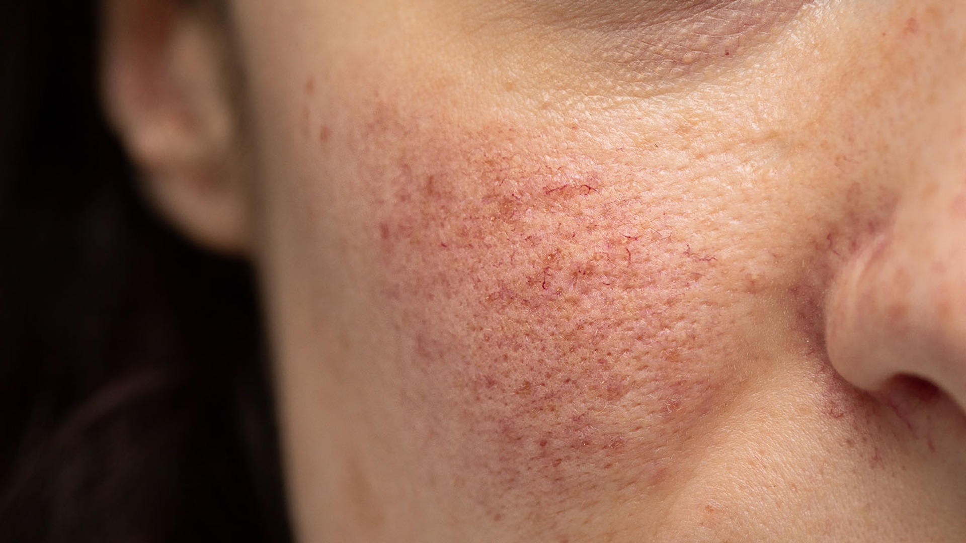 Close-up of a person's cheek showing redness and small visible blood vessels, indicative of rosacea or skin irritation.