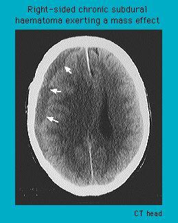 CT scan of a human head showing a right-sided chronic subdural hematoma with white arrows indicating areas of mass effect