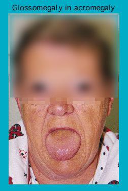 Close-up of a person with acromegaly showing symptom of glossomegaly, with blurred facial features for privacy